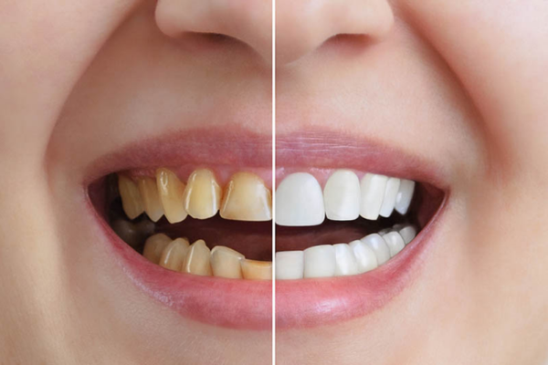 Professional teeth whitening at Blossom Dental Care Moshi