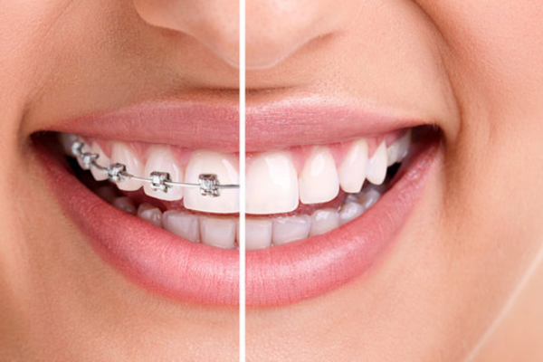 Orthodontic Braces and Aligner Treatment at Blossom Dental Care Pune