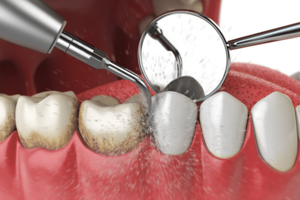 Periodontal Gum Treatment at Blossom Dental Care Pune