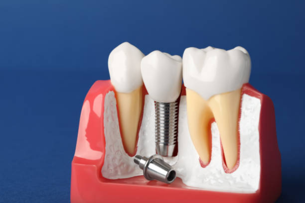 Prosthodontic Dental Crown Treatment at Blossom Dental Care Pune